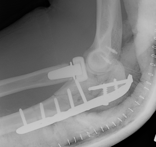 Elbow Dislocation ORIF Olecranon Replace Radial Heal LCL repair